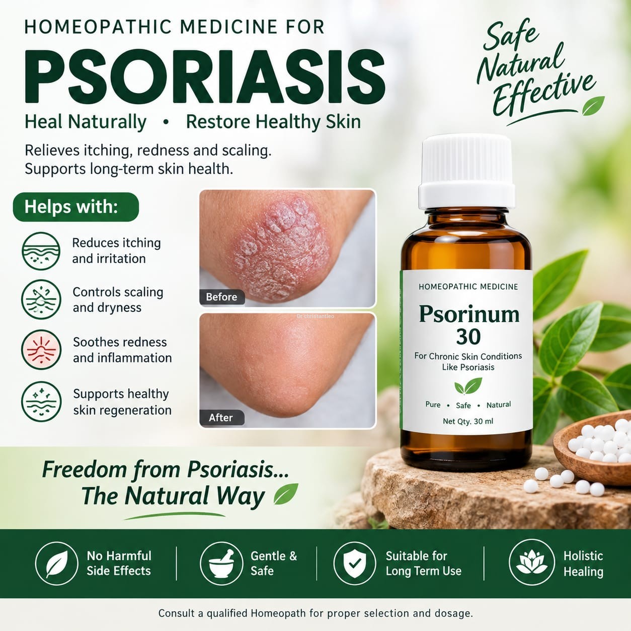 Best Homeopathy Psoriasis medicine