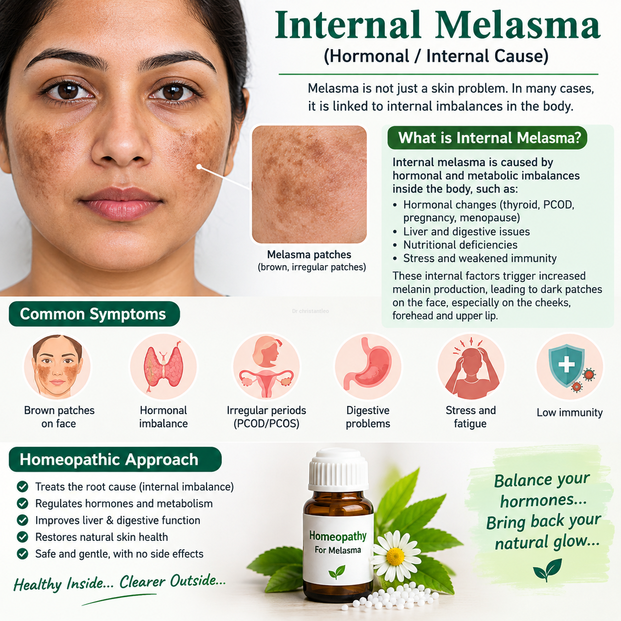 Spl homeopathy internal melasma medicine